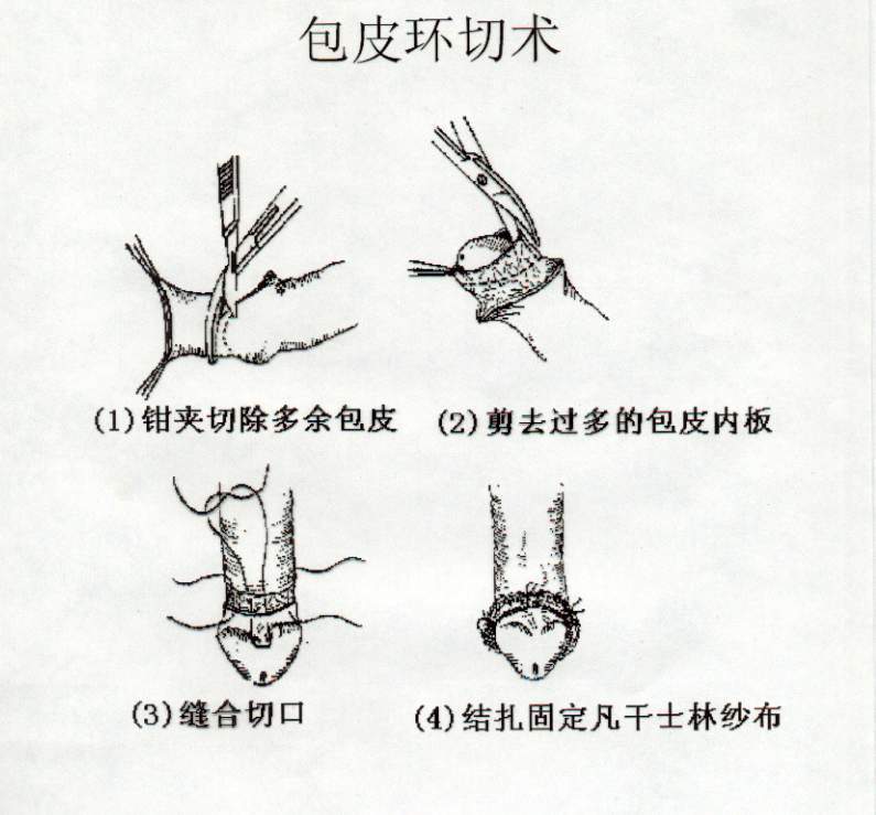 现代医疗革新，包皮手术最新技术探索